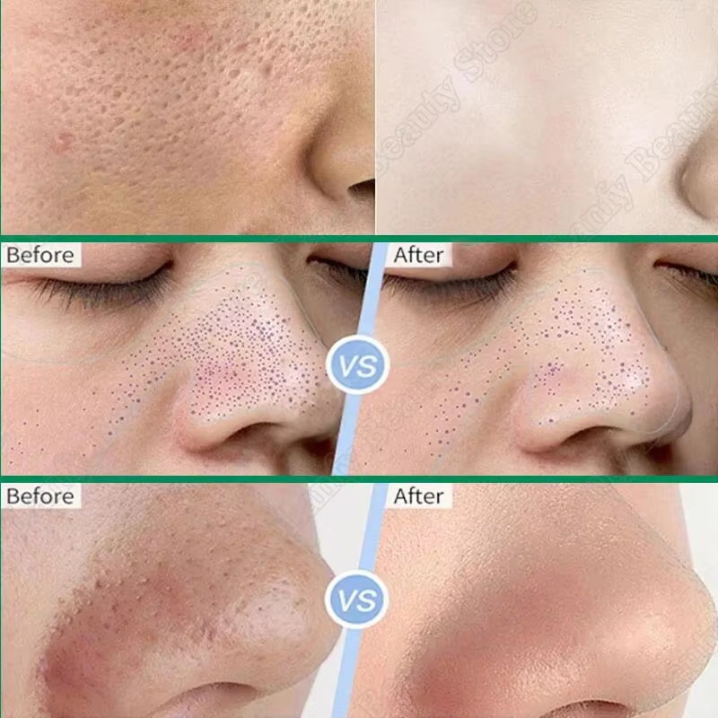Salicylic Acid Pore Clearing C - Salicylic Acid Blackhead Remover review and price